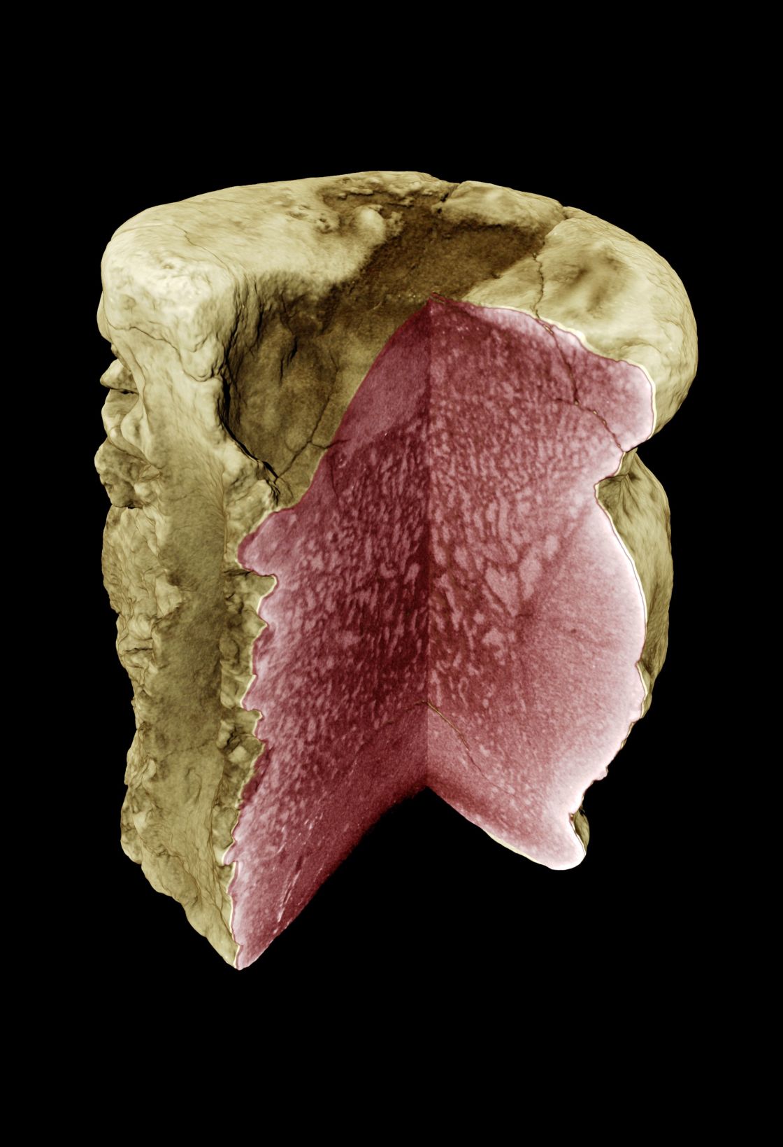 In dem Bild wurden mit Synchrotron-Holotomografie krankhafte Strukturvernderungen in einem Dinosaurierknochen sichtbar gemacht - vergrerte Ansicht